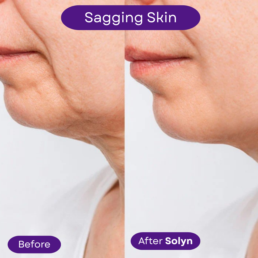 Solyn™ ProbioDerm