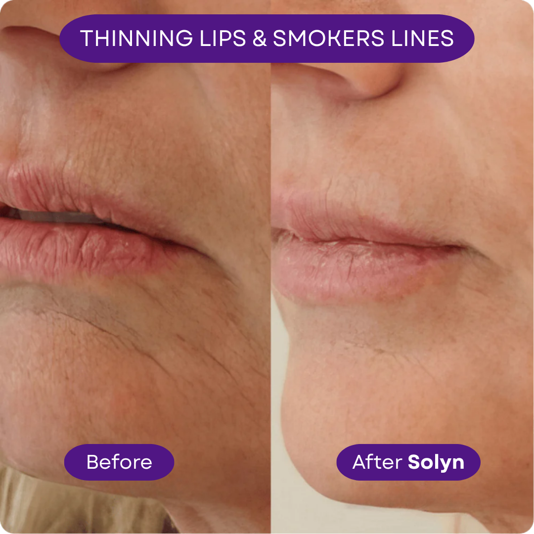 Solyn™ ProbioDerm