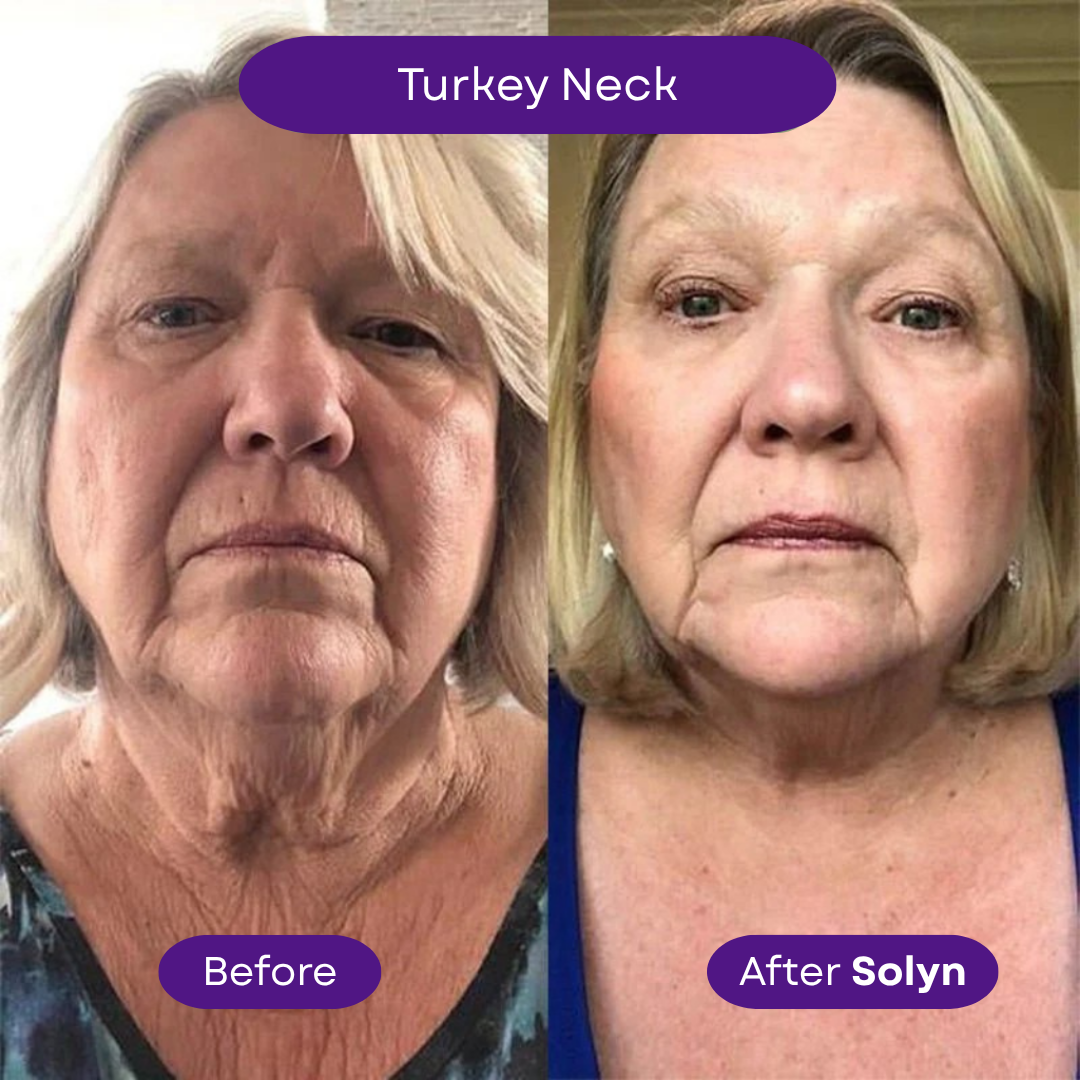 Solyn™ ProbioDerm