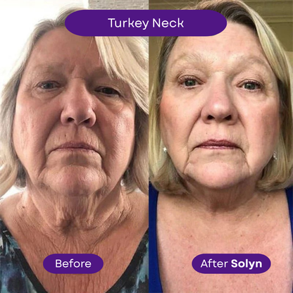 Solyn™ ProbioDerm